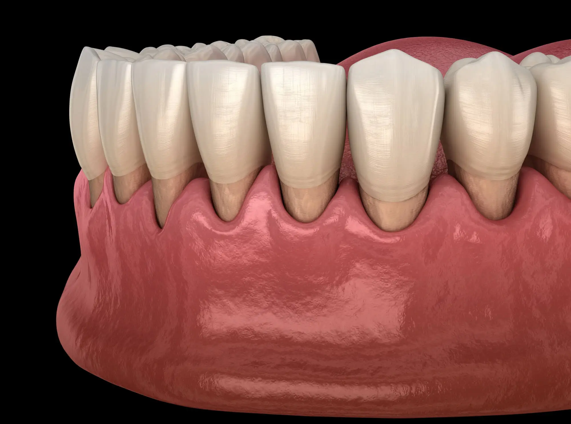 Why Is Periodontal Maintenance in New York Important