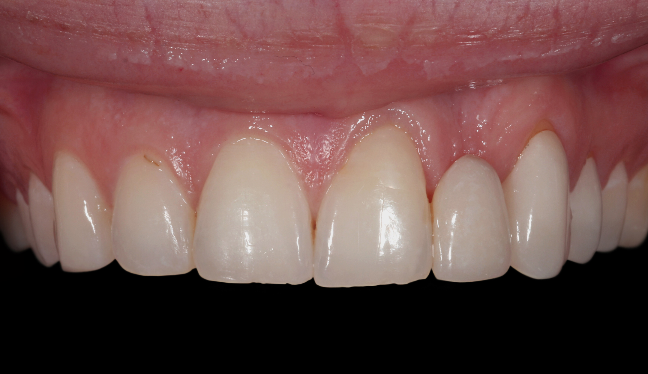 before full mouth gum grafting
