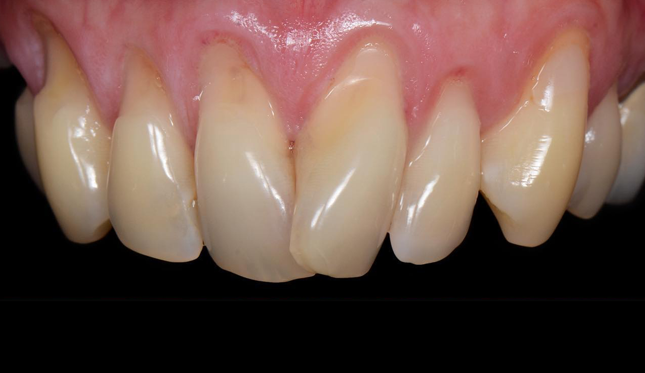 before full mouth gum grafting