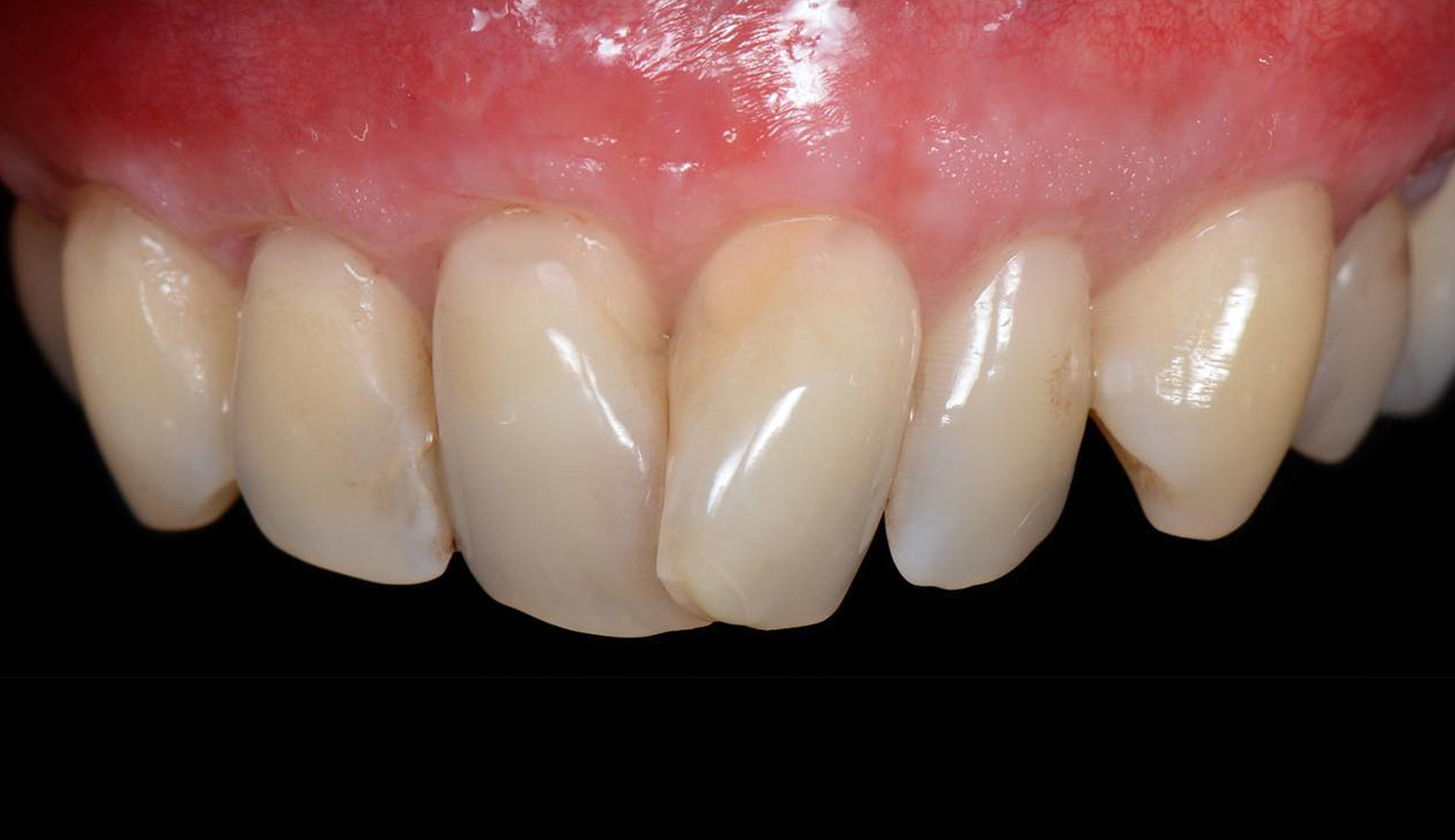 before full mouth gum grafting